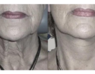 Устранение дряблости кожи 